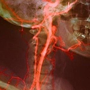 Carotid Disease | Dr JP Mouton