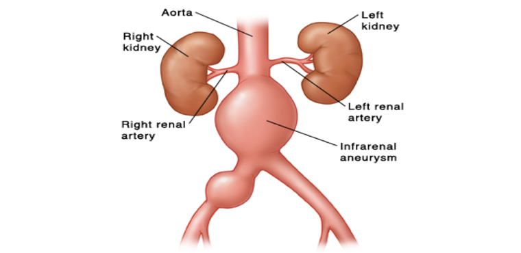 Abdominal Aneurysm Treatment | Vascular Surgeon Cape Town