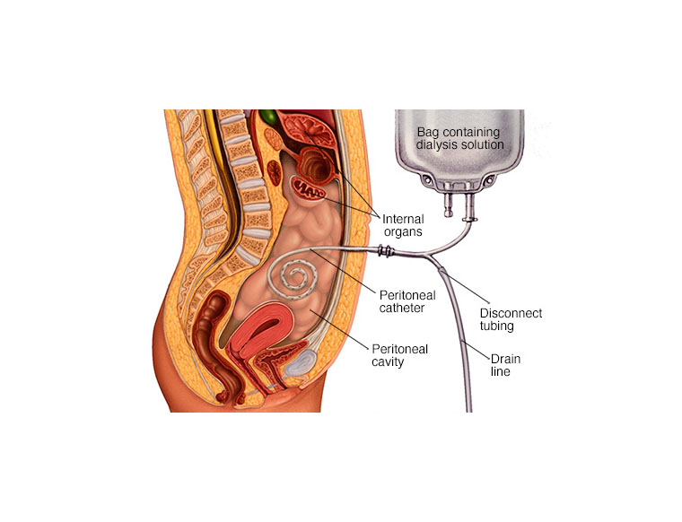 Dialysis Access Cape Town | Mouton Vascular