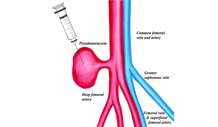 False Aneurysm Treatment | Dr JP Mouton