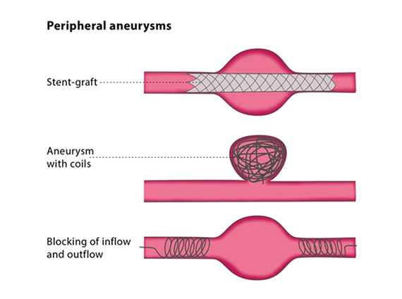 Aneurysm Treatment Cape Town | Dr JP Mouton