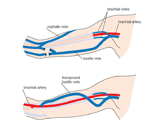 Dialysis Access Cape Town | Salvage of Failing AV Fistulas