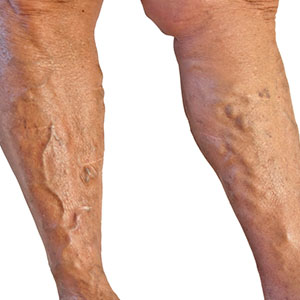 Varicose Veins | Vascular Surgeon Cape Town