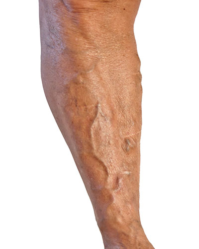 Varicose Veins Treatment Cape Town | Dr JP Mouton